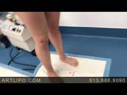 Cankles Can Be An Embarrassing Characteristic Contact Art Lipo Of Florida For A Ankle Liposuction Proc Liposuction Liposuction Procedure Tumescent Liposuction