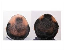 Biotin Hair Growth Before And After Pictures Men Dermaroller For Hair Loss Before And After Result In Male Patient Hair Loss Men Derma Roller Hair Loss Pictures