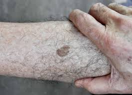 Image result for Pigment stains on the shin