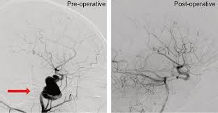 A swollen area on the wall of an artery 2. Aneurysm Brain Aneurysm Ucla Cerebrovascular Program Los Angeles Ca