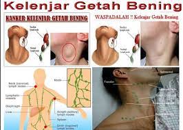Sensitif terhadap terapi sehingga memiliki potensi yang lebih. Pengalaman Operasi Kelenjar Getah Bening Lymphoma Limfoma Indoasuransi Pengalaman Review Asuransi Kesehatan Cashless