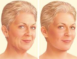 Facelift