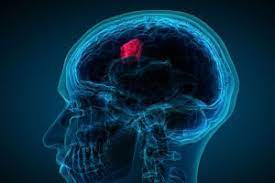 Here are some early warning signs of brain cancer. What Are The Actual Warning Signs Of A Brain Tumor Health Essentials From Cleveland Clinic