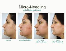 Sounds scary, but secretly holds the key to smooth, flawless and hydrated skin. Before During And After Results Photos From Micro Needling With Hyaluronic Acid Ah Laser Aesthetics