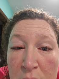 Is it an allergic reaction to eyelash extensions?