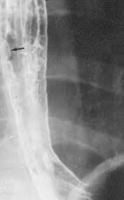 Mayo clinic board review, 2nd edition. Alimentary Tract Disease In The Hiv Patient Esophageal Diseases And Swallowing Disorders Infectious Disease Advisor