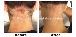 Discover hair removal deals in and near barrie, on and save up to 70% off. Magic Laser And Aesthetics Laser Hair Removal