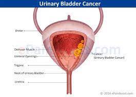 Other symptoms of advanced bladder cancer may include pain in the back or pelvis, unexplained appetite loss, and weight loss. Urinary Bladder Cancer Treatment In Pune Prolife Cancer Centre