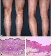 Image result for Microscopic Polyangiitis