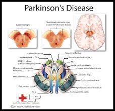 Parkinsons Disease Parkinsons Disease Nursing Parkinsons Disease Parkinsons Disease Awareness