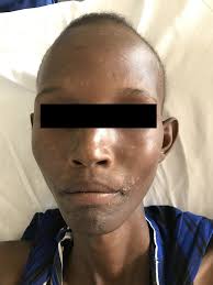 Hypopigmented spots perioral as a feature of post-kala-azar dermal...