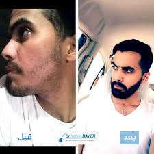 قبل وبعد زراعة اللحية Face Makeup Halloween Face Makeup Face