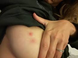 Red spots on breast… IBC?? : rbigboobproblems