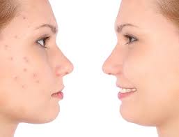 Welcome back to q&a time with dr. Birth Control Pills Can Help Reduce Acne Types Side Effects