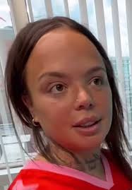 Cranial Facial Dysplasia Kayla