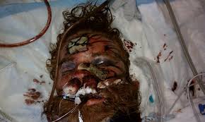 WARNING: Graphic Photo of FPD Beating Victim - Friends For Fullertons  Future