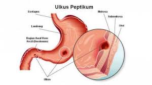 Selamat malam, sterima kasih atas pertanyaan andasakit pada ulu hati adalah rasa sakit atau tidak nyaman pad aperut bagian atas tengah, atau di dada bawah bagian tengah. Tukak Lambung Bisa Sebabkan Maag Dan Nyeri Ulu Hati Kenali Gejala Gejalanya Sebelum Semakin Parah Tribun Cirebon