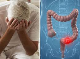 Colorectal cancer might not cause symptoms right away. Seven Bowel Cancer Warning Signs To Look Out For Irish Mirror Online