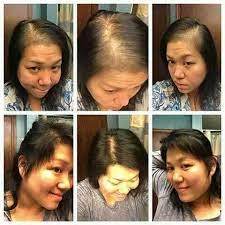 I Love To See Results And Testimonials Like This Ones After I Had My Baby All My Hair Fell Out Literally I Hair Loss Cure Hair Loss Women Hair Falling Out