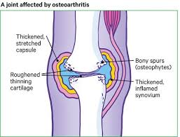 Low impact exercises like stationary or recumbent bicycles, elliptical trainers, or exercise in the water help keep joint stress low while you move. Osteoarthritis Oa Of The Knee Knee Pain Versus Arthritis