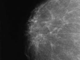 Many Women with Dense Breasts May Not Need Additional Screening - National  Cancer Institute