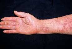 Image result for dermatitis contacta toxica