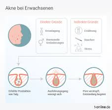Es gibt einige sogenannte antiandrogene verhütungspillen, welche ausschließlich zur behandlung von akne, also nicht zur reinen verhütung 2 maxim pille für schöne haut? Was Hilft Gegen Akne Bei Erwachsenen
