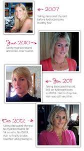 Get emergency medical help if you have signs of an allergic reaction: Hypothyroidism Ruined My Hair Miss Lizzy Thyroid Support