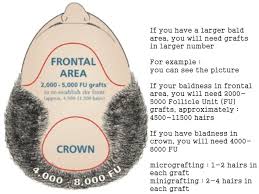 pin by sana sarwar on how much does a hair transplant cost