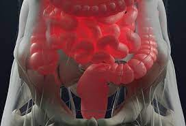 This is called the stage. Rectal Cancer Symptoms Vs Hemorrhoids Differences
