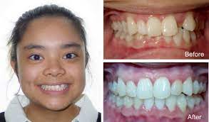 Those must be the typical questions that protocol before in the palate expansion guide , invisalign is a common technique for orthodontists to deal with cases such as crossbite, underbite in most cases, braces are a great solution to fix a crossbite. What Is Crossbite Symptoms Diagnosis And Treatment