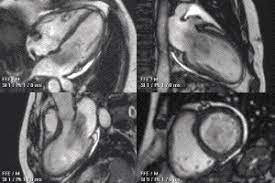Cardiac Magnetic Resonance Imaging Wikipedia