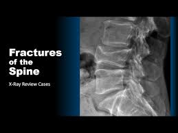 Image result for Fracture XRay