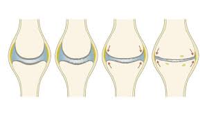Arthrose Ursachen Symptome Und Behandlung Ottobock De
