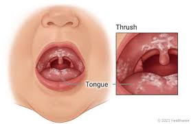 Image result for Oral thrush roof of mouth