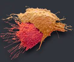 Because the signs of ovarian cancer are common and somewhat vague, it's hard to know when to call the doctor. We Must Find Ways To Detect Cancer Much Earlier Scientific American