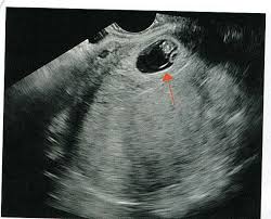 Image result for First Trimester Ultrasound