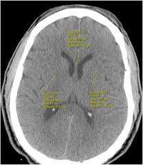 Image result for CT Head