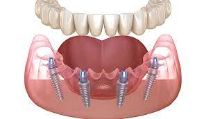 You may want to join a dental discount program that offers attractive discounts on implants. All On 4 Dental Implants Problems Dental Implants Houston