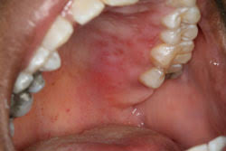 Image result for Oral herpes roof of mouth