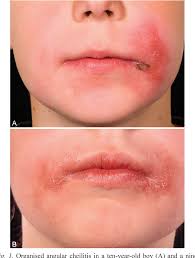 Image result for Angular Stomatitis