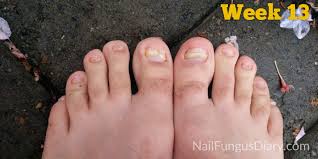 Nail Fungus Update April 2015 Nail Fungus Diary