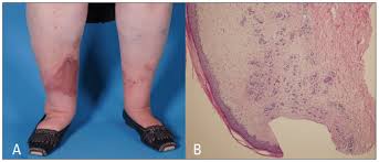 Find out if your smartphone's gpu can handle the latest games such as pubg and fortnite. Pseudo Kaposi Sarcoma Worsening After Leg Vein Harvest For Coronary Artery Bypass Grafting Annals Of Saudi Medicine