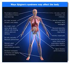 Often Confused With Ms Due To Some Overlapping Symptoms Sjogren S Body Illustration Large Sjogrens Syndrome Sjogrens Chronic Fatigue Syndrome
