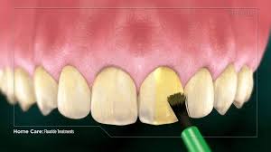 Globalnews.ca your source for the latest news on molar sealant. Dental Sealants And Fluoride Huntington Beach Ca Ford Dental Group