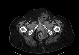 In the very next year, the company faced the unexpected loss of mr. Fournier Gangrene Radiology Case Radiopaedia Org