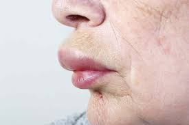 12.06.2020 · if a glass of milk or a slice of pizza causes swollen lips, hives, or other significant symptoms, you may have an allergy to casein, a protein in milk.another milk protein associated with food. Photos And Symptoms Of Common Food Allergy Symptoms