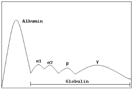 Multiple myeloma proliferation of plasma cells bone pain is main symptom patient lands up in hospital with pathological fracture classic triad for diagnosis. Serum Protein Electrophoresis Wikipedia