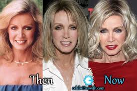 It up against a random cosmetic surgery procedure. Donna Mills Plastic Surgery Facelift Necklift Before And After Pictures Celebritieswith Com