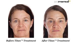 Cutera Titan® Skin Tightening Treatment